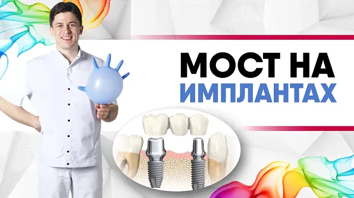 Мост на имплантах [ металлокерамика, цирконий ]. Несъёмные протезы на имплантантах, коронки.